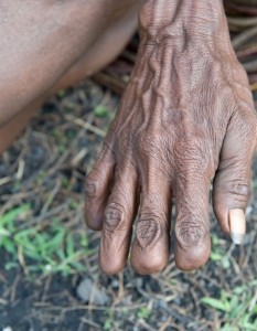 2. Рязане на пръсти – Индонезия
Тази ужасяваща традиция се практикува от членовете на племето Дани в Индонезия. След като загубят свой близък, те трябва да отрежат един от пръстите си в знак на емоционалната болка, която преживяват и респект към духа на загиналия. Традицията все пак не е често спазвана заради усложненията след отрязването на пръста.