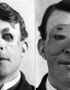 Уолтър Йео, първият човек подложил се на пластична операция и трансплантация на кожа. 1917 година.